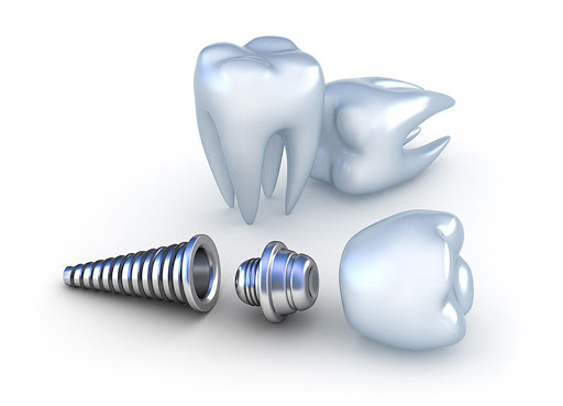 Titanium Implants