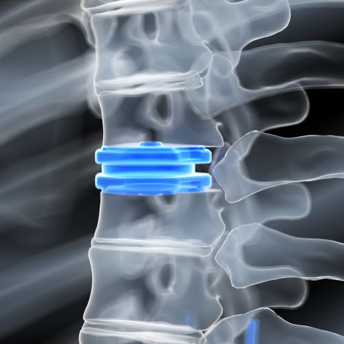Titanium Implants